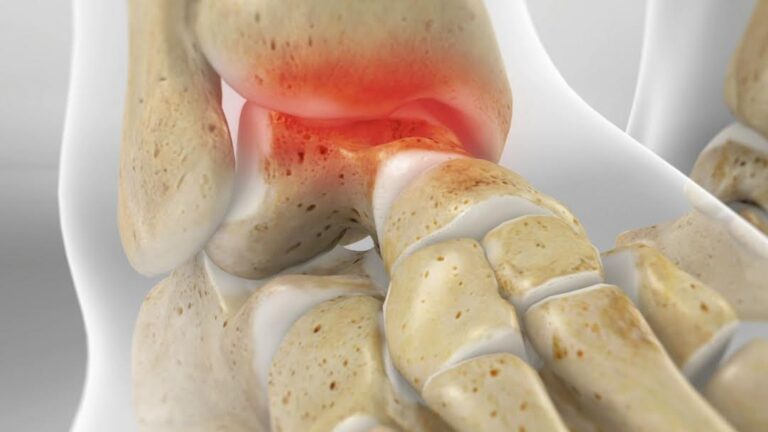 Ankle Cartilage Injury Di Nallo Orthopaedics