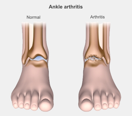 Ankle Arthritis - Di Nallo Orthopaedics