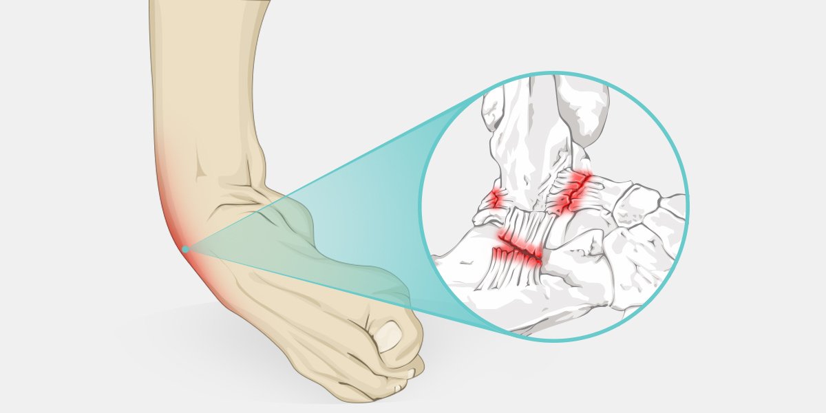 Ankle Instability - Di Nallo Orthopaedics