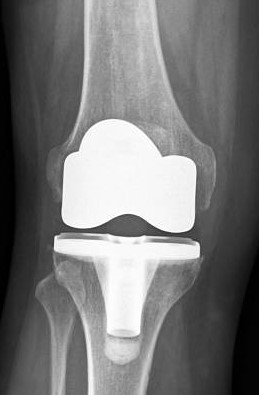 Knee arthroplasty or knee replacement is a surgical procedure to resurface a knee damaged by arthritis. The goal of knee replacement surgery is to resurface the parts of the knee joint that have been damaged and to relieve knee pain.