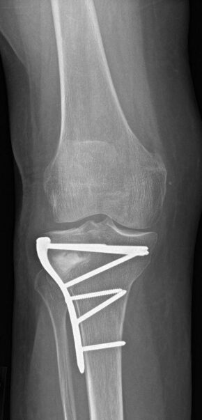 High tibial osteotomy or H.T.O operation the alignment of the leg is changed. Degenerative arthritis. Cuts in the top of the tibia or shin bone. Delays the need for knee replacement.