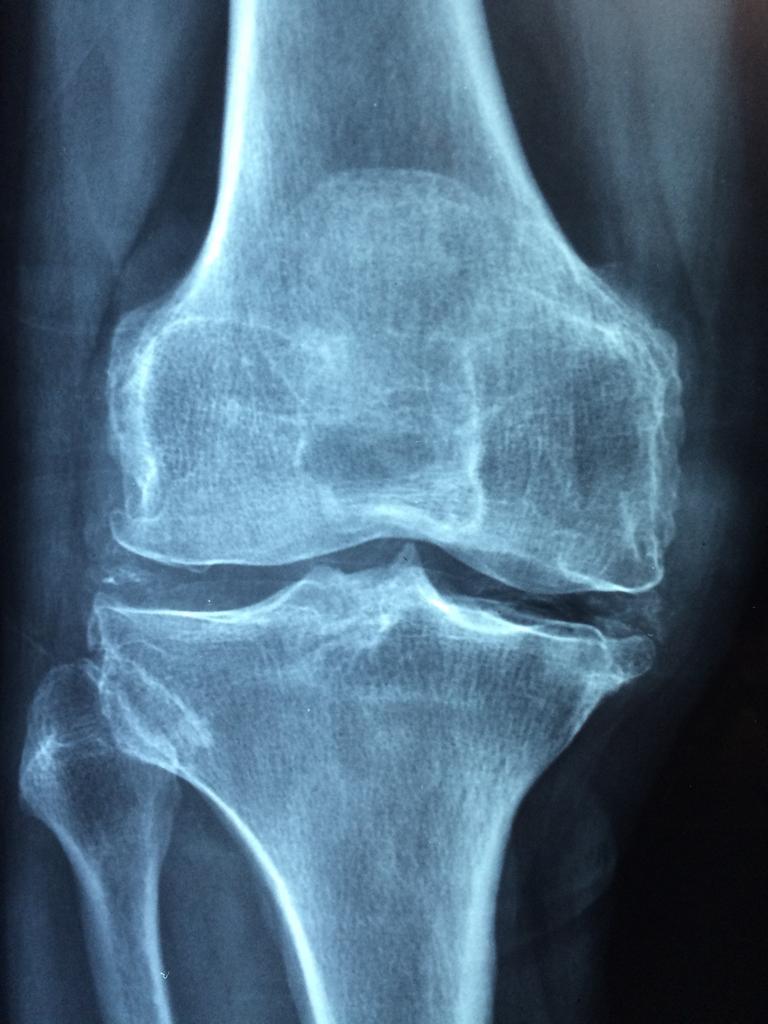X-ray of the articular surfaces of the knee with bone-spurs. Caused by wear and tear. Pain can cause a feeling of weakness, resulting in locking or buckling. Types are osteoarthritis, rheumatoid arthritis and post-traumatic arthritis. Surgical corrections are osteotomy, partial replacement and total replacement.